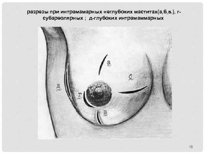 разрезы при интрамамарных неглубоких маститах(а, б, в. ), гсубареолярных ; д-глубоких интрамаммарных 10 