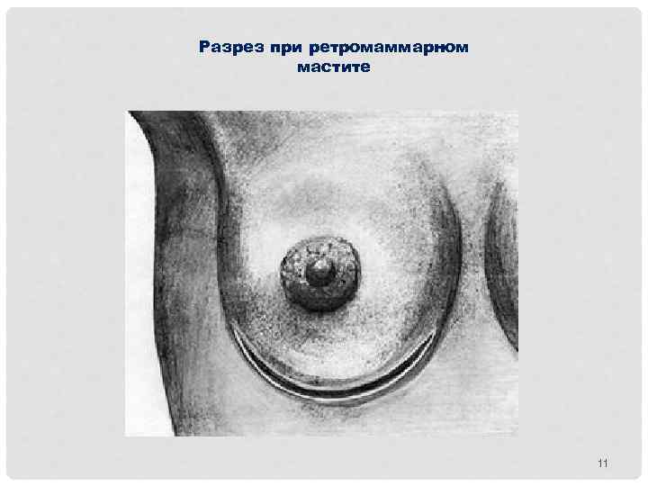 Разрез при ретромаммарном мастите 11 