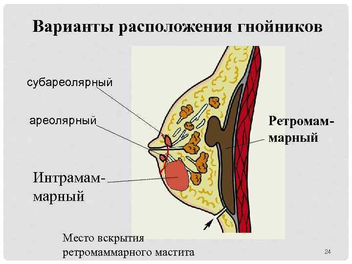 Варианты расположения гнойников субареолярный Ретромаммарный Интрамаммарный Место вскрытия ретромаммарного мастита 24 