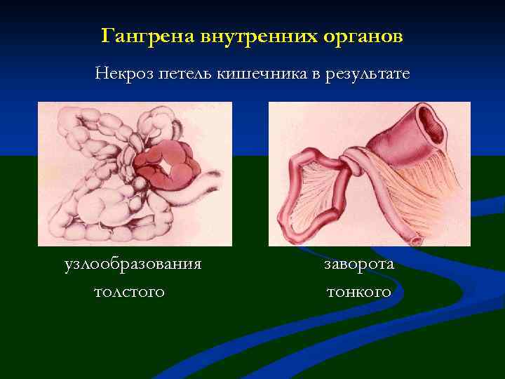 Гангрена внутренних органов Некроз петель кишечника в результате узлообразования толстого заворота тонкого 