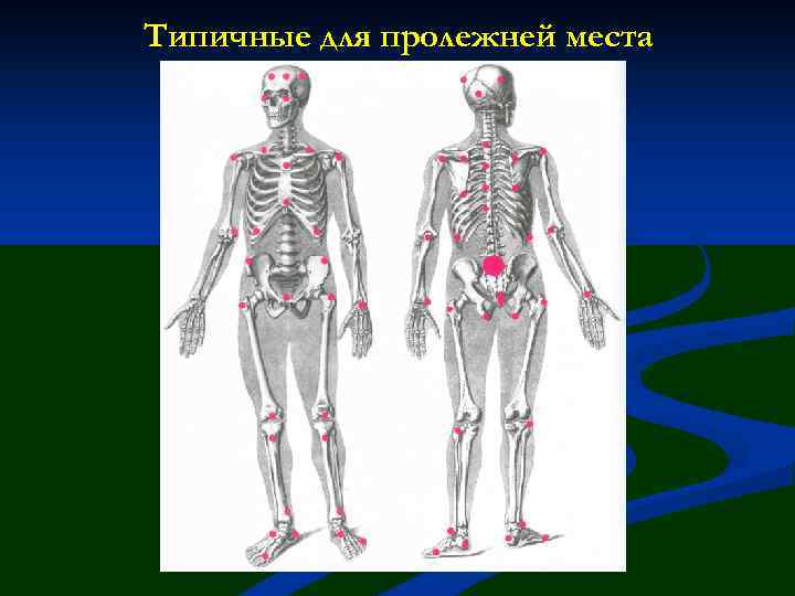 Типичные для пролежней места 