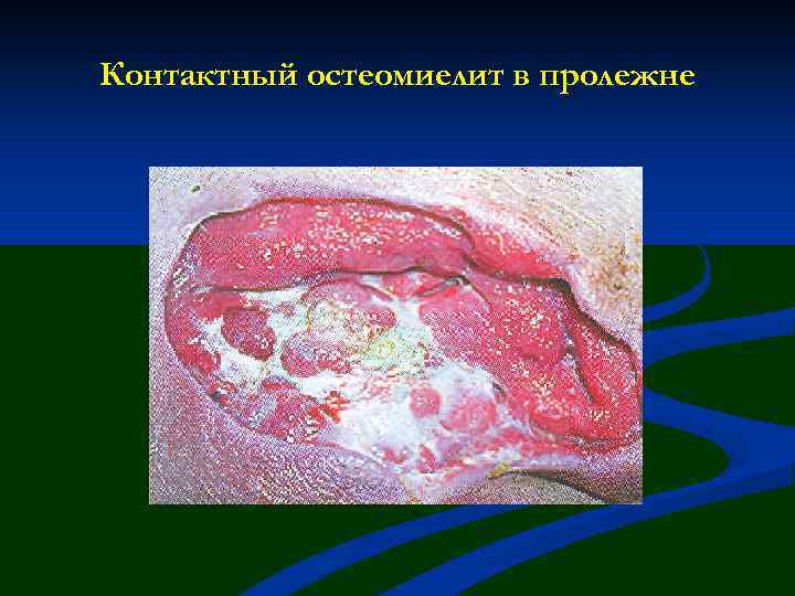 Контактный остеомиелит в пролежне 