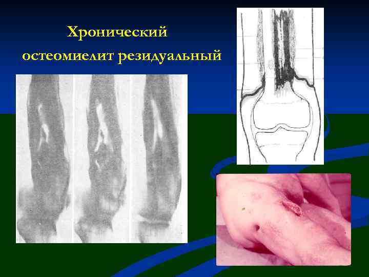 Хронический остеомиелит резидуальный 