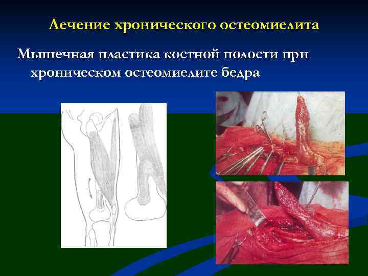 Лечение хронического остеомиелита Мышечная пластика костной полости при хроническом остеомиелите бедра 