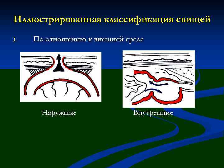 Иллюстрированная классификация свищей I. По отношению к внешней среде Наружные Внутренние 