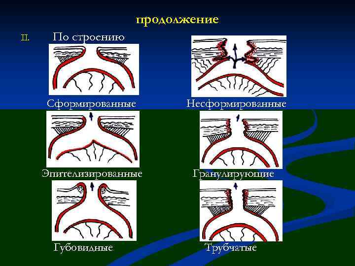 продолжение II. По строению Сформированные Несформированные Эпителизированные Гранулирующие Губовидные Трубчатые 