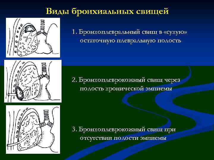 Виды бронхиальных свищей 1. Бронхоплевральный свищ в «сухую» остаточную плевральную полость 2. Бронхоплеврокожный свищ