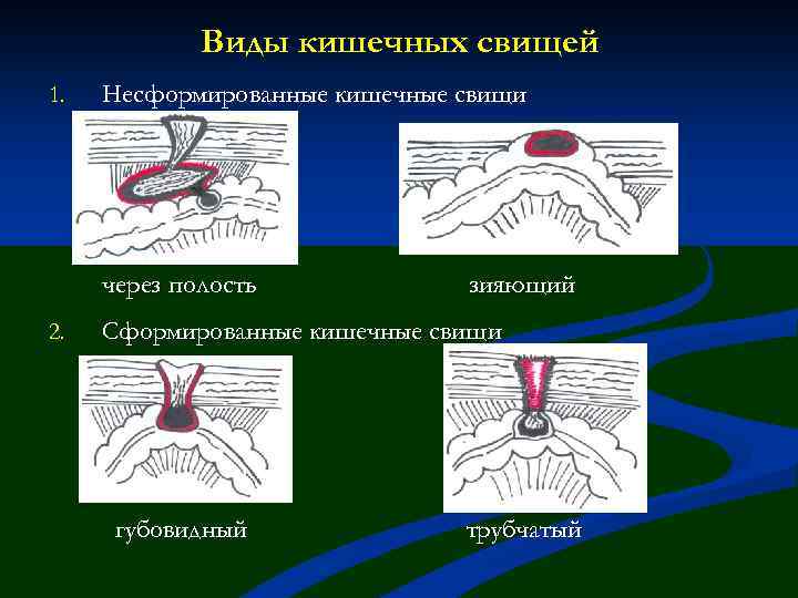 Виды кишечных свищей 1. Несформированные кишечные свищи через полость 2. зияющий Сформированные кишечные свищи