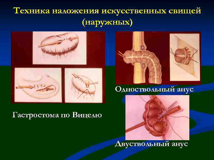 Техника наложения искусственных свищей (наружных) Одноствольный анус Гастростома по Вицелю Двуствольный анус 