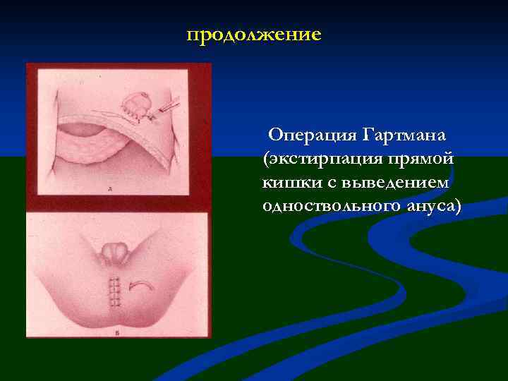 продолжение Операция Гартмана (экстирпация прямой кишки с выведением одноствольного ануса) 