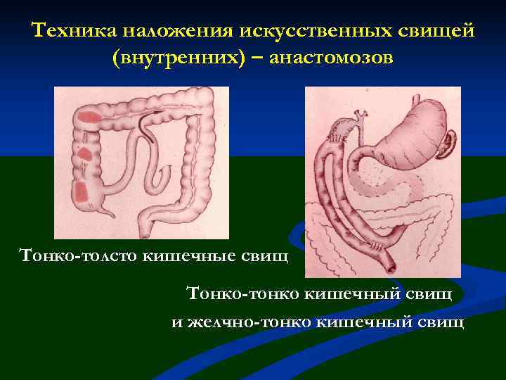 Техника наложения искусственных свищей (внутренних) – анастомозов Тонко-толсто кишечные свищ Тонко-тонко кишечный свищ и