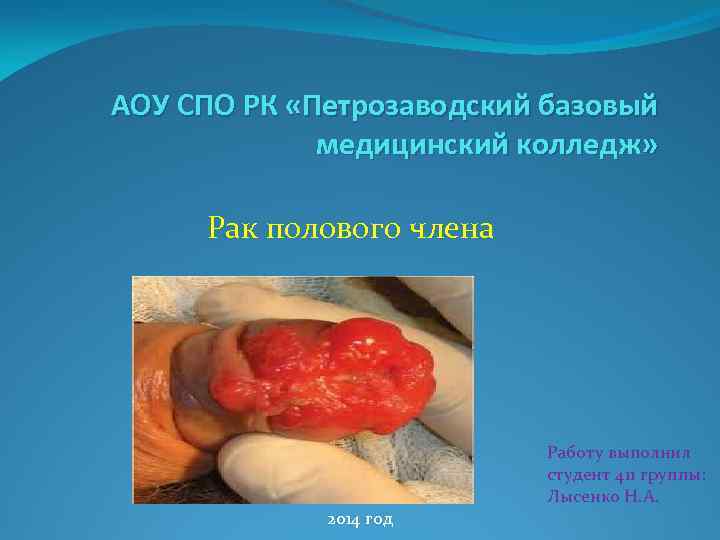 АОУ СПО РК «Петрозаводский базовый медицинский колледж» Рак полового члена Работу выполнил студент 411