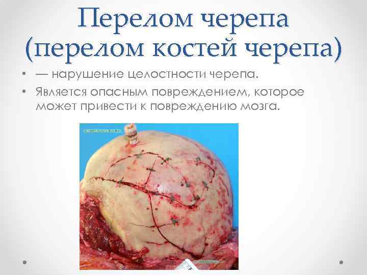 Перелом черепа (перелом костей черепа) • — нарушение целостности черепа. • Является опасным повреждением,