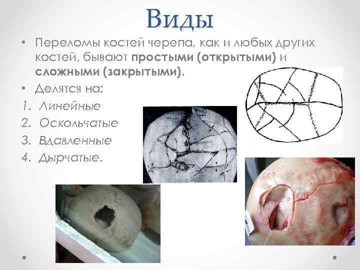 Виды • Переломы костей черепа, как и любых других костей, бывают простыми (открытыми) и