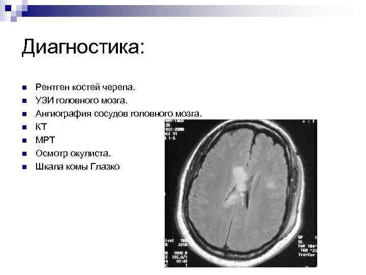 Диагностика: n n n n Рентген костей черепа. УЗИ головного мозга. Ангиография сосудов головного