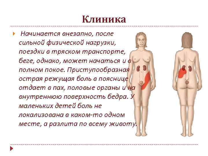 Клиника Начинается внезапно, после сильной физической нагрузки, поездки в тряском транспорте, беге, однако, может