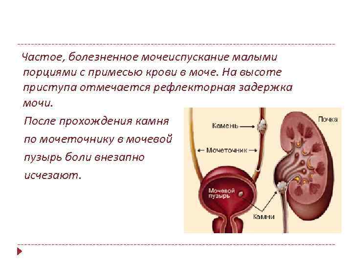  Частое, болезненное мочеиспускание малыми порциями с примесью крови в моче. На высоте приступа