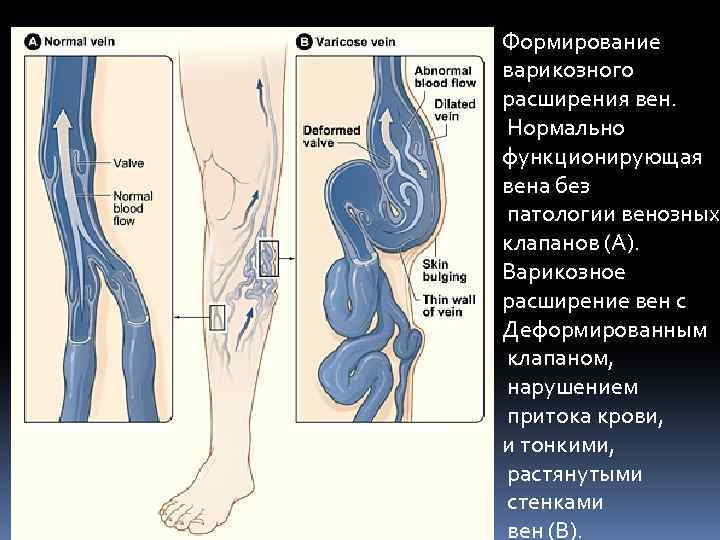 Формирование варикозного расширения вен. Нормально функционирующая вена без патологии венозных клапанов (А). Варикозное расширение