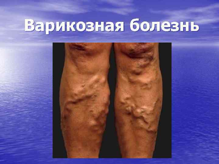 Варикозная болезнь 