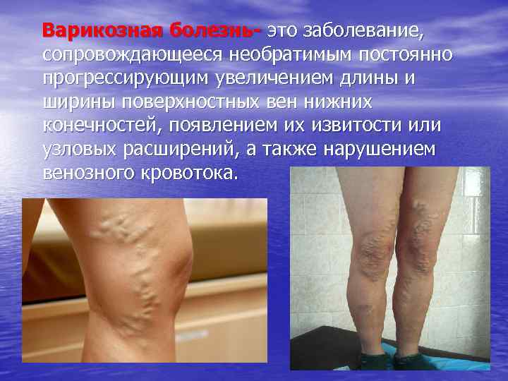 Варикозная болезнь- это заболевание, сопровождающееся необратимым постоянно прогрессирующим увеличением длины и ширины поверхностных вен
