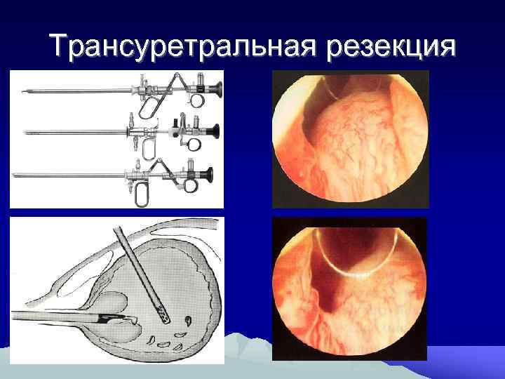 Аденома предстательной железы карта вызова смп