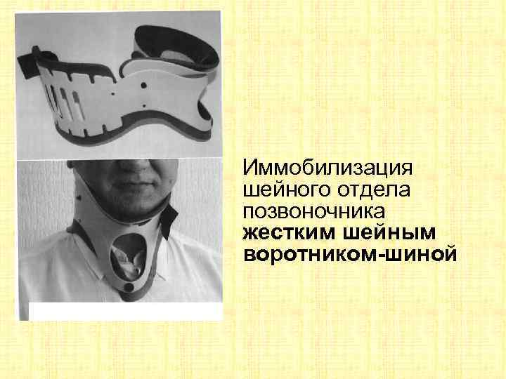 Иммобилизация шейного отдела позвоночника жестким шейным воротником-шиной 