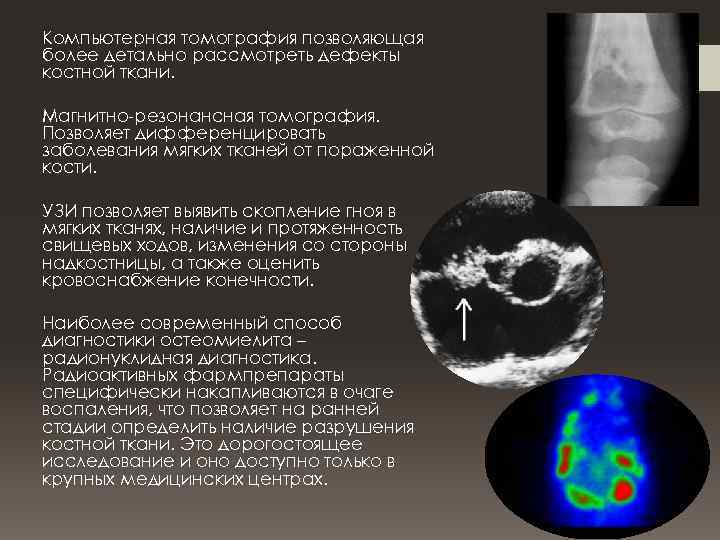 Компьютерная томография позволяющая более детально рассмотреть дефекты костной ткани. Магнитно-резонансная томография. Позволяет дифференцировать заболевания