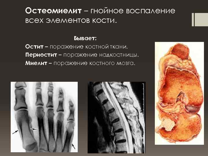 Остеомиелит – гнойное воспаление всех элементов кости. Бывает: Остит – поражение костной ткани. Периостит