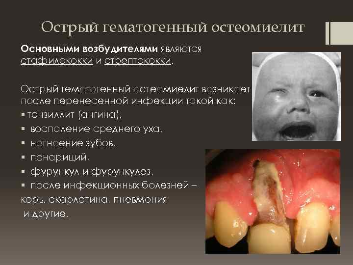 Острый гематогенный остеомиелит Основными возбудителями являются стафилококки и стрептококки. Острый гематогенный остеомиелит возникает после