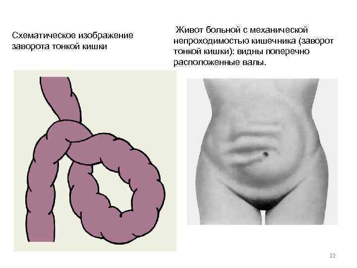Схематическое изображение заворота тонкой кишки Живот больной с механической непроходимостью кишечника (заворот тонкой кишки):