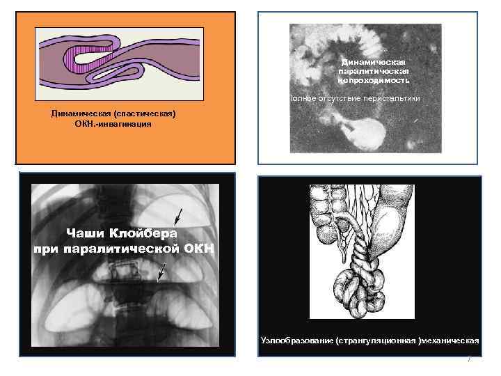 Динамическая паралитическая непроходимость Полное отсутствие перистальтики Динамическая (спастическая) ОКН. -инвагинация Чаши Клойбера при паралитической