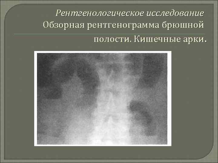 Рентгенологическое исследование Обзорная рентгенограмма брюшной полости. Кишечные арки. 