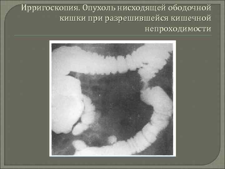 Ирригоскопия. Опухоль нисходящей ободочной кишки при разрешившейся кишечной непроходимости 