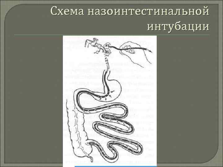 Схема назоинтестинальной интубации 