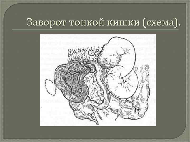 Заворот тонкой кишки (схема). 
