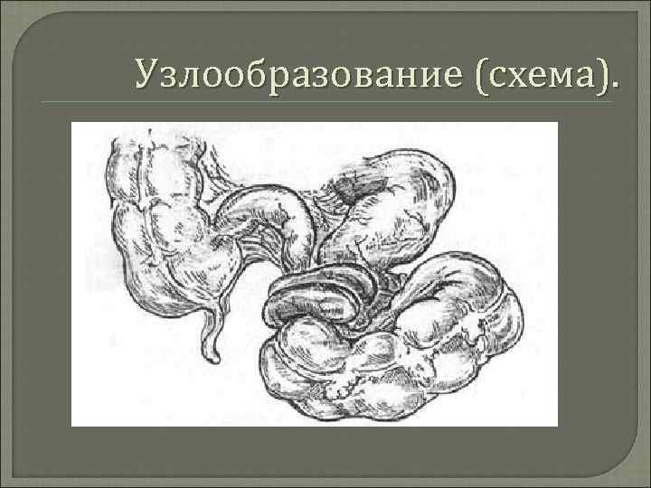 Узлообразование (схема). 