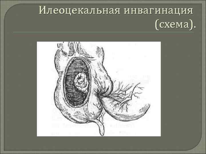 Илеоцекальная инвагинация (схема). 