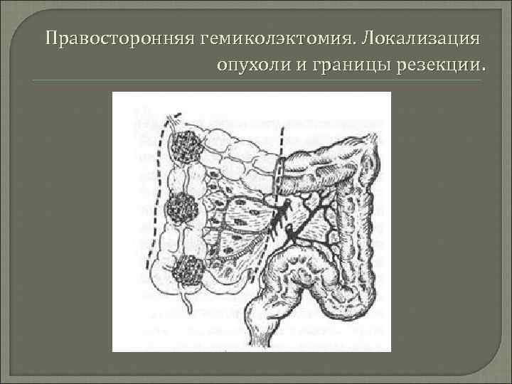 Правосторонняя гемиколэктомия. Локализация опухоли и границы резекции. 