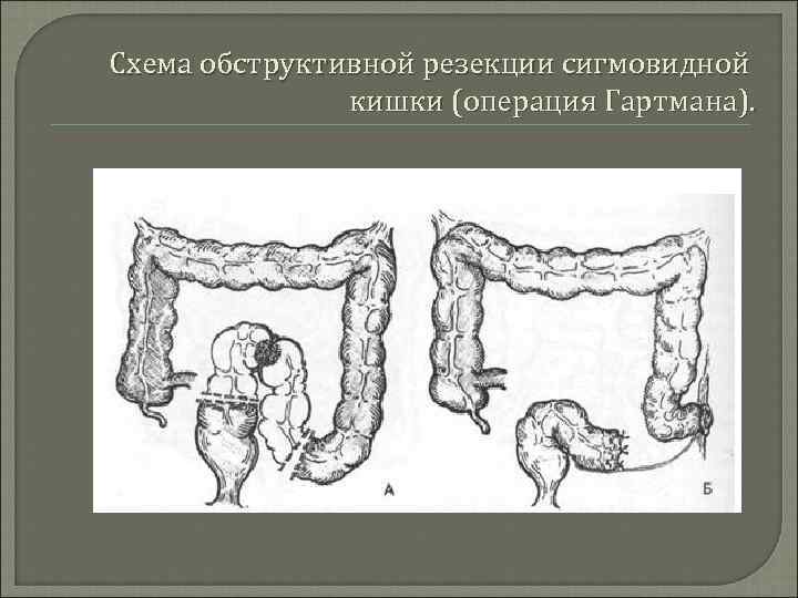 Схема обструктивной резекции сигмовидной кишки (операция Гартмана). 