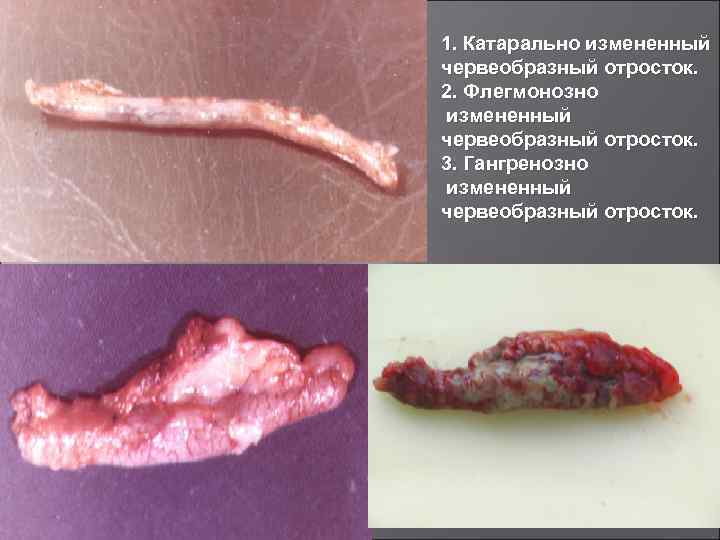1. Катарально измененный червеобразный отросток. 2. Флегмонозно измененный червеобразный отросток. 3. Гангренозно измененный червеобразный