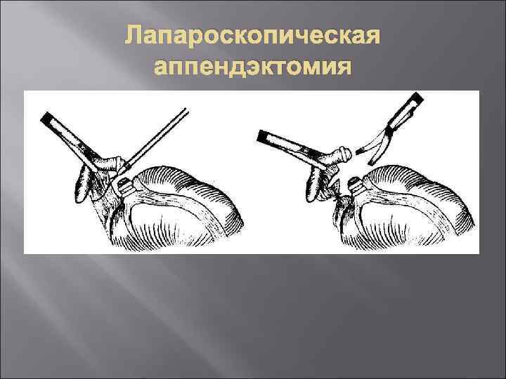 Лапароскопическая аппендэктомия 