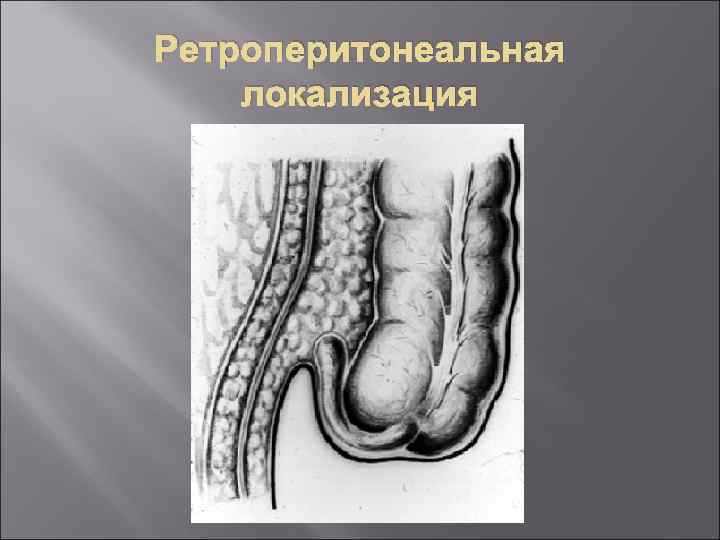 Ретроперитонеальная локализация 