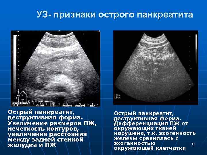 УЗ- признаки острого панкреатита Острый панкреатит, деструктивная форма. Увеличение размеров ПЖ, нечеткость контуров, увеличение