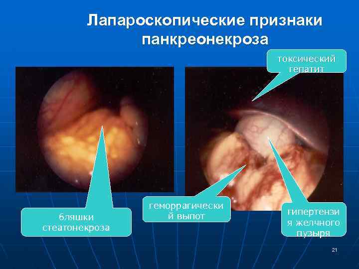 Лапароскопические признаки панкреонекроза токсический гепатит бляшки стеатонекроза геморрагически й выпот гипертензи я желчного пузыря