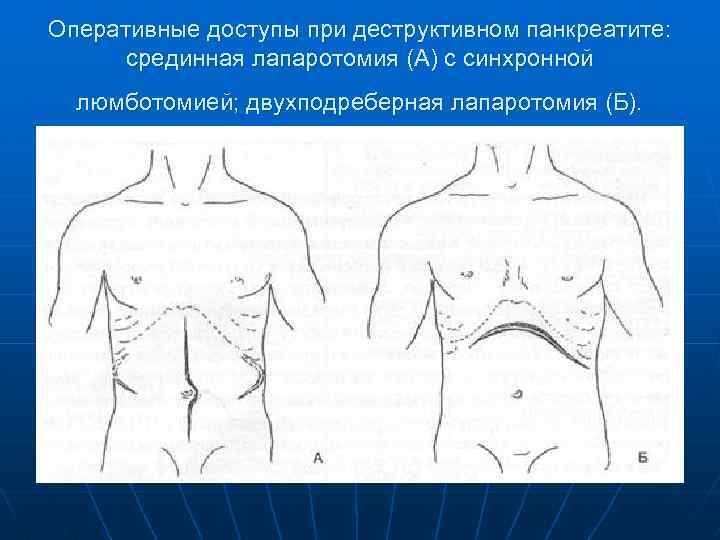 Оперативные доступы при деструктивном панкреатите: срединная лапаротомия (А) с синхронной люмботомией; двухподреберная лапаротомия (Б).