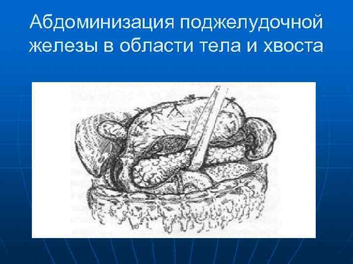 Абдоминизация поджелудочной железы в области тела и хвоста 