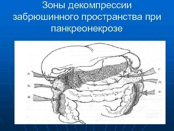 Зоны декомпрессии забрюшинного пространства при панкреонекрозе 