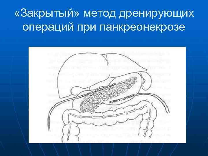  «Закрытый» метод дренирующих операций при панкреонекрозе 