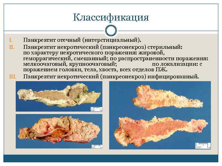 Классификация I. II. III. Панкреатит отечный (интерстициальный). Панкреатит некротический (панкреонекроз) стерильный: по характеру некротического