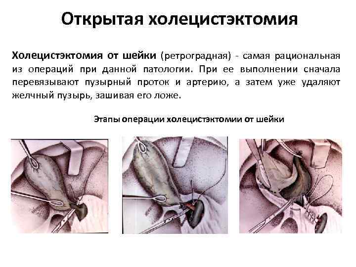 Открытая холецистэктомия Холецистэктомия от шейки (ретроградная) - самая рациональная из операций при данной патологии.